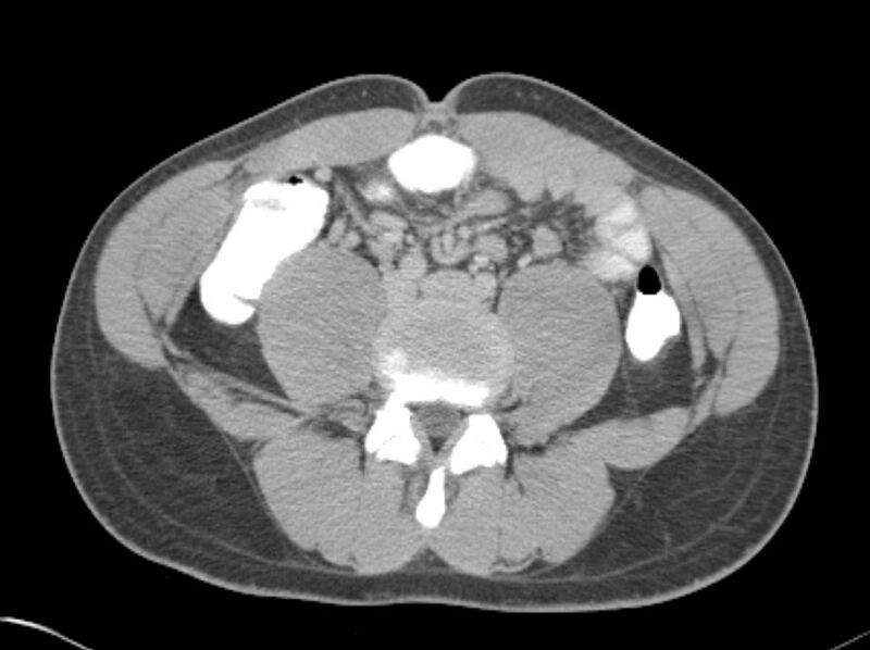 File:Appendicitis and incidental foregut duplication cyst (Radiopaedia 52962-58916 A 52).jpg
