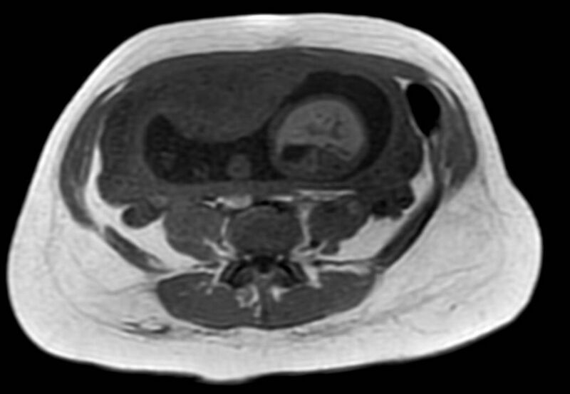 File:Appendicitis in gravida (MRI) (Radiopaedia 89433-106395 Axial T1 in-phase 44).jpg
