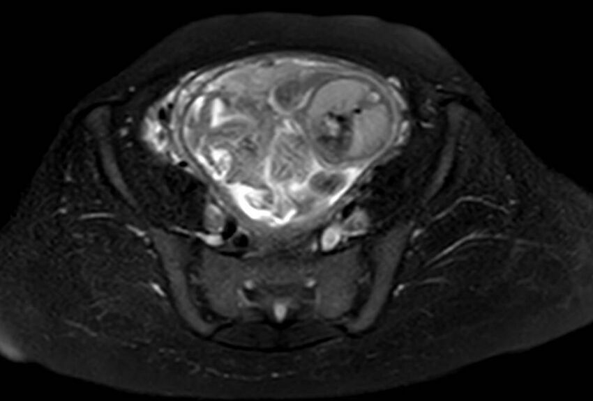 Appendicitis in gravida (MRI) (Radiopaedia 89433-106395 Axial T2 SPAIR 58).jpg