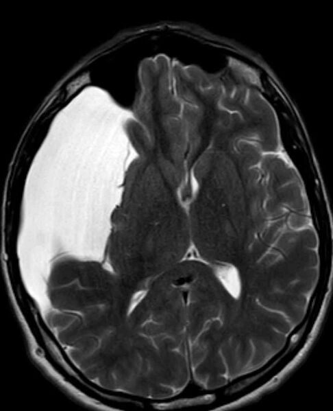 File:Arachnoid cyst- extremely large (Radiopaedia 68741-78451 Axial T2 14).jpg