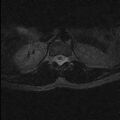 Arachnoid cyst - spinal (Radiopaedia 66835-76157 Axial T2 2).jpg