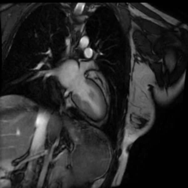 File:Arrhythmogenic right ventricular cardiomyopathy (Radiopaedia 87505-103850 2ch (LV) Cine SSFP 48).jpg
