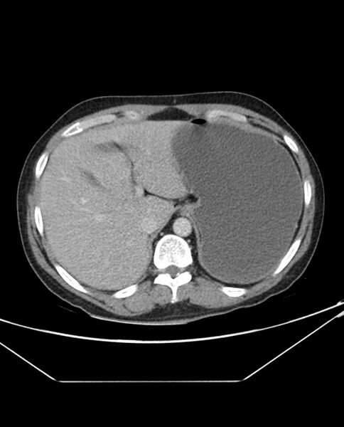 File:Arterial occlusive mesenteric ischemia (Radiopaedia 84641-100054 A 22).jpg