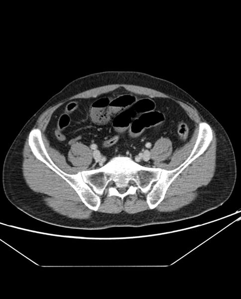 File:Arterial occlusive mesenteric ischemia (Radiopaedia 84641-100054 A 91).jpg