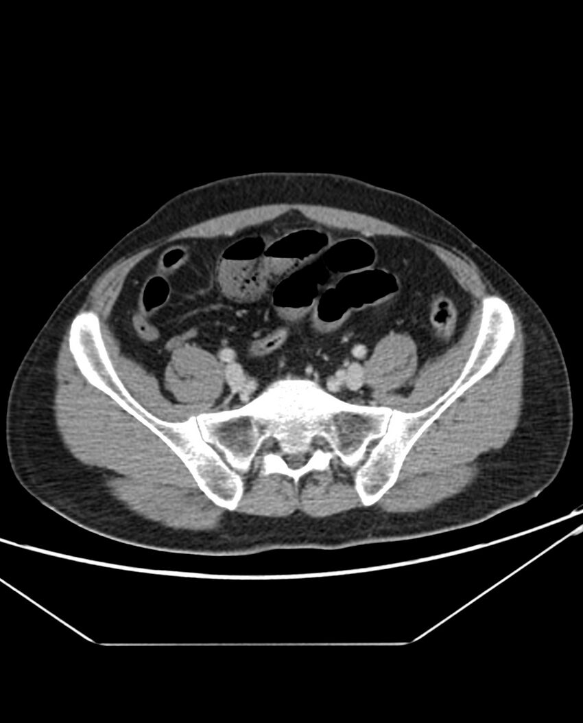 Arterial occlusive mesenteric ischemia (Radiopaedia 84641-100054 A 91).jpg