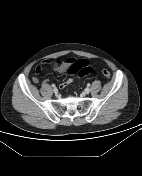 File:Arterial occlusive mesenteric ischemia (Radiopaedia 84641-100054 A 93).jpg