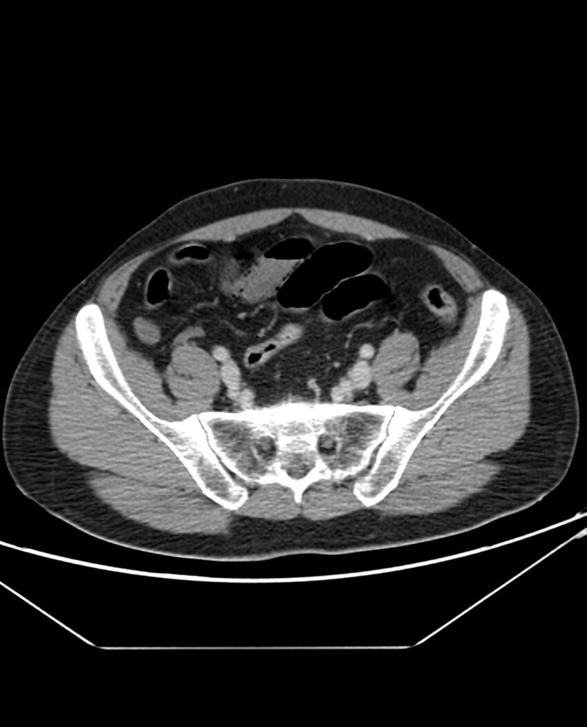 Arterial occlusive mesenteric ischemia (Radiopaedia 84641-100054 A 93).jpg