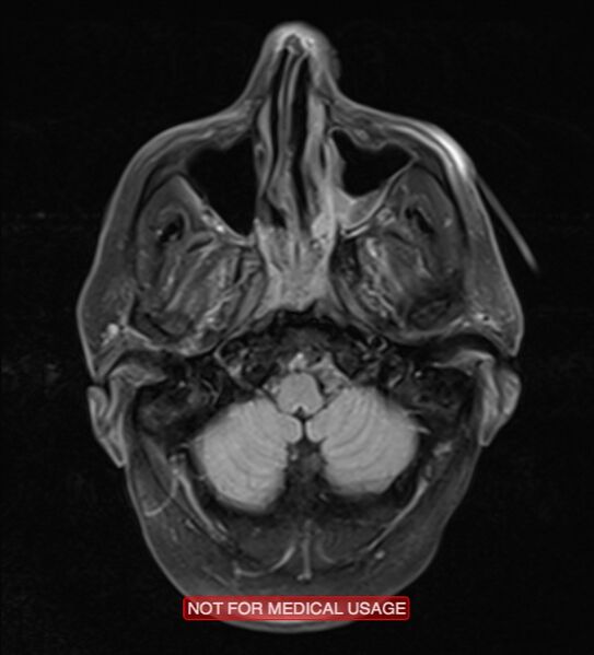 File:Artery of Percheron infarction (Radiopaedia 28679-28968 Axial FLAIR 5).jpg