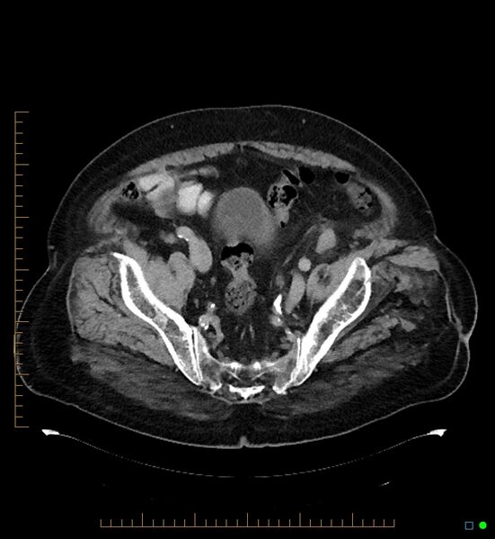 File:Artificial urethral sphincter (Radiopaedia 46937-51464 A 1).jpg