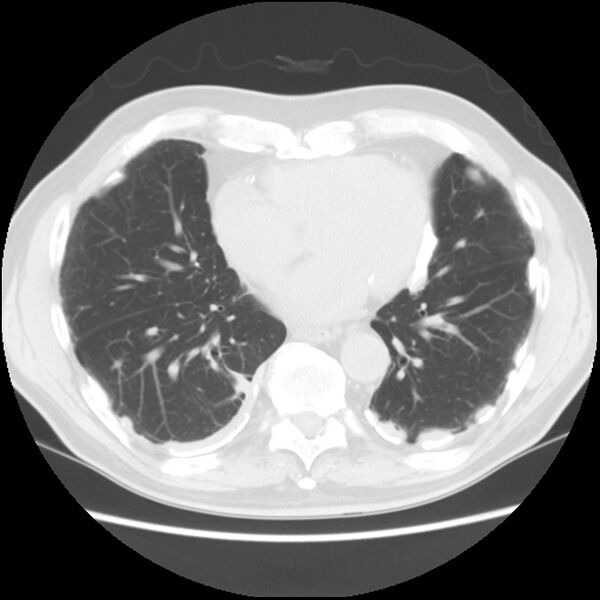 File:Asbestos-related pleural plaques (Radiopaedia 39069-41255 Axial lung window 48).jpg