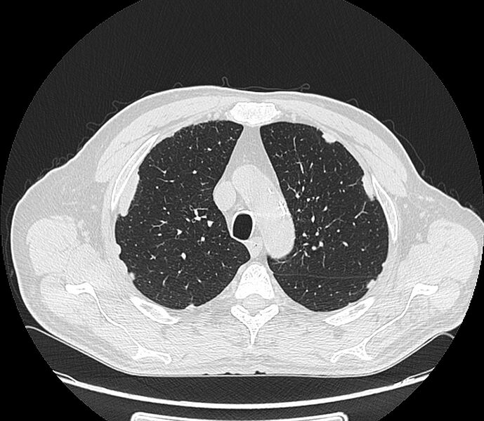 File:Asbestos pleural placques (Radiopaedia 57905-64872 Axial lung window 70).jpg