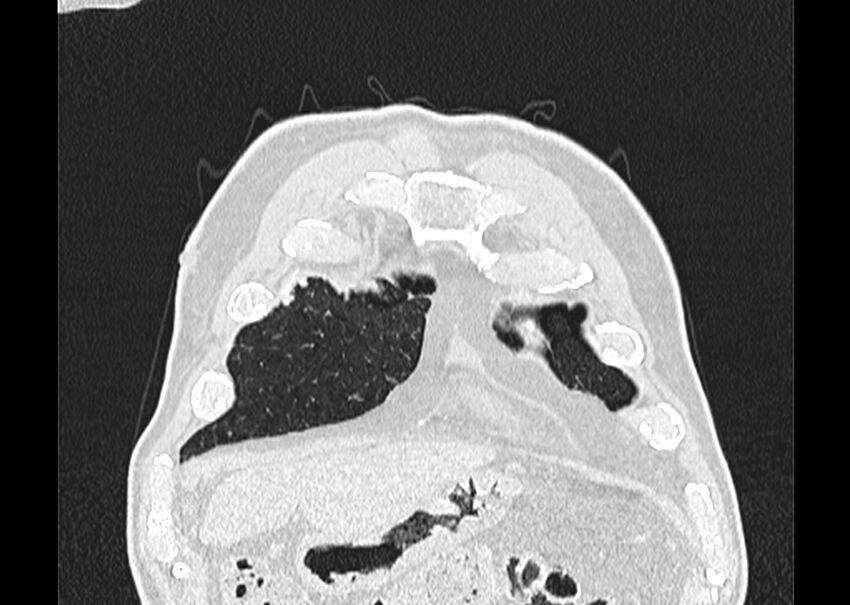 Asbestos pleural placques (Radiopaedia 57905-64872 Coronal lung window 19).jpg