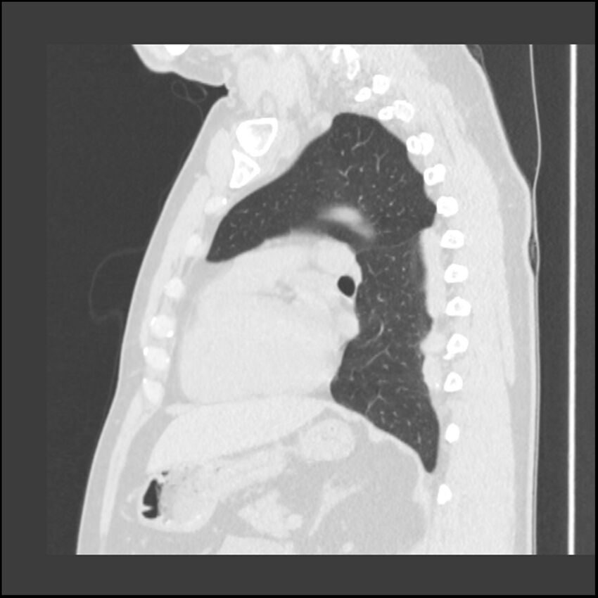 Asbestosis (Radiopaedia 45002-48961 Sagittal lung window 52).jpg