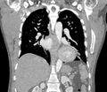 Ascending aortic aneurysm (Radiopaedia 86279-102297 B 42).jpg