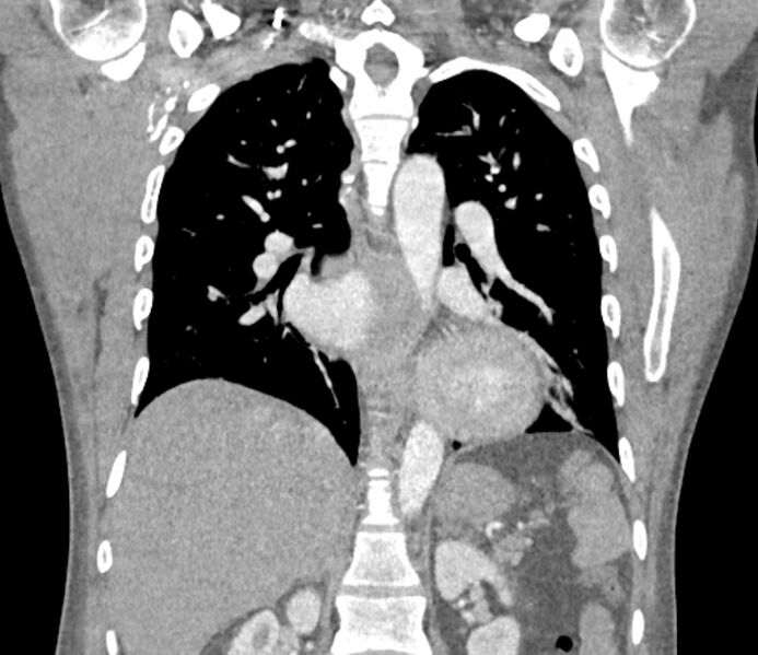File:Ascending aortic aneurysm (Radiopaedia 86279-102297 B 42).jpg