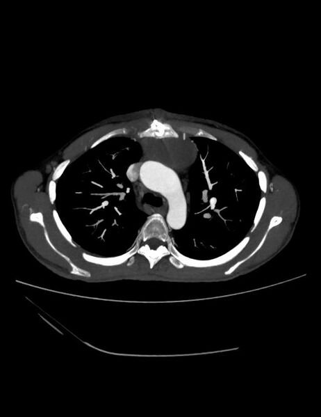 File:Ascending aortic pseudoaneurysm (Radiopaedia 28638-28910 A 7).jpg