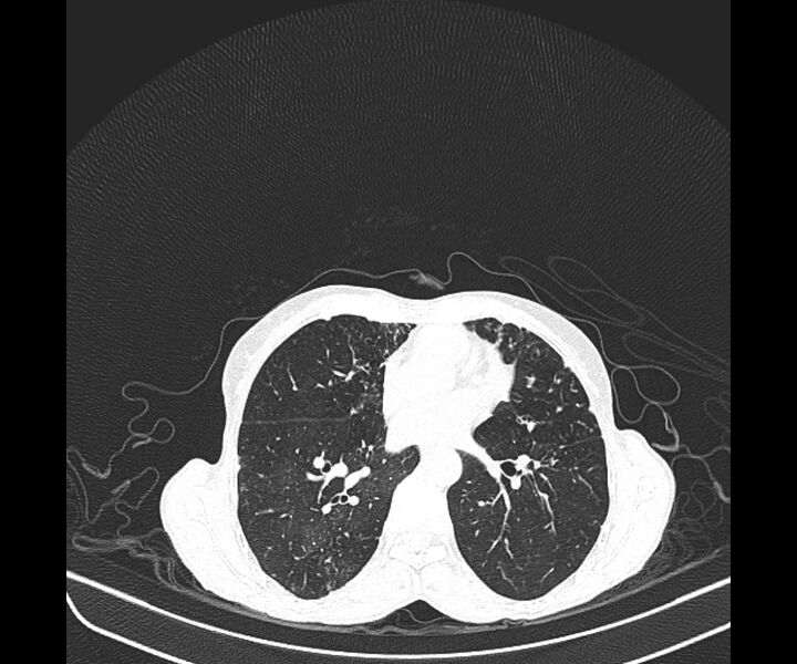 File:Aspergillomas (Radiopaedia 66779-76110 Axial lung window 27).jpg