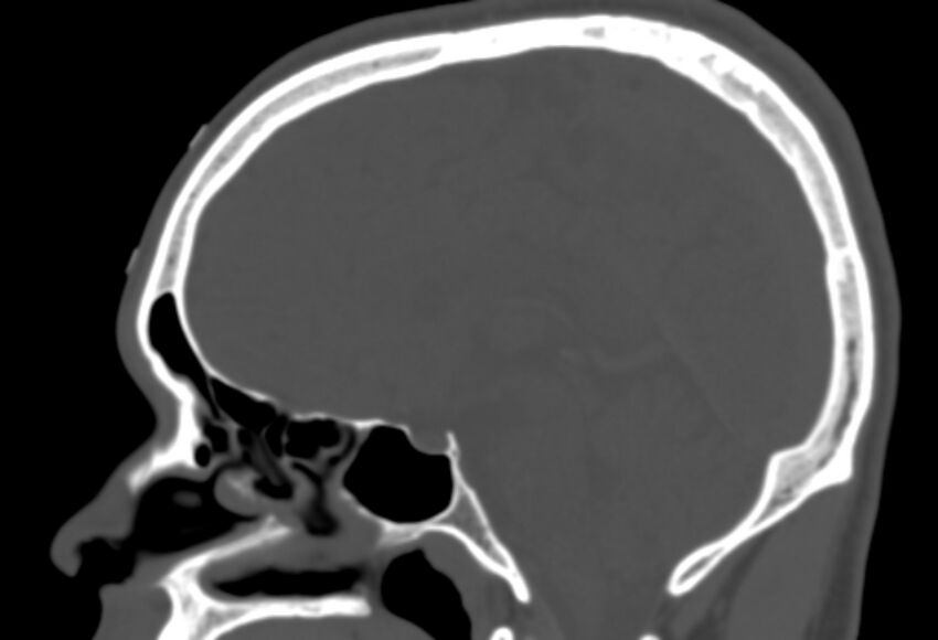 Asymptomatic occipital spur (Radiopaedia 87753-104201 Sagittal bone window 156).jpg