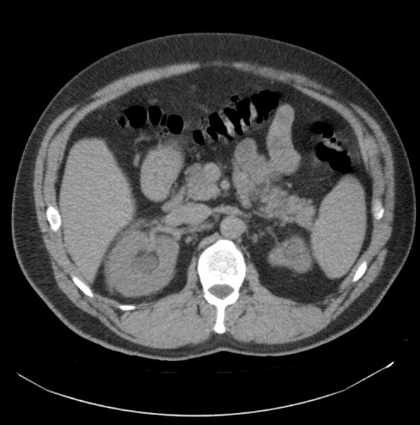 File:Atrophic kidney due to severe chronic obstructive hydronephrosis (Radiopaedia 40828-43474 Axial non-contrast 2).jpg