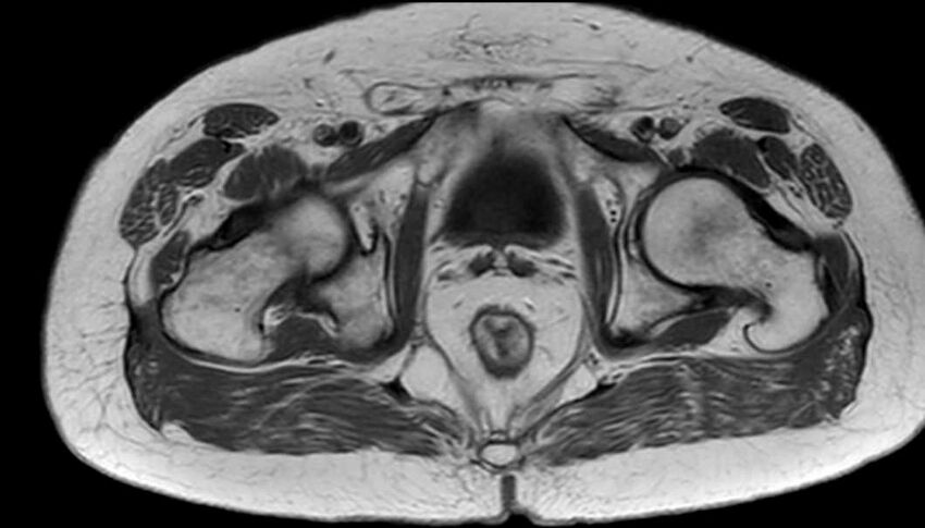 Atypical lipomatous tumor - thigh (Radiopaedia 68975-78734 Axial T1 90).jpg