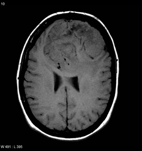 File:Atypical meningioma (WHO grade II) (Radiopaedia 7762-8586 Axial T1 1).jpg