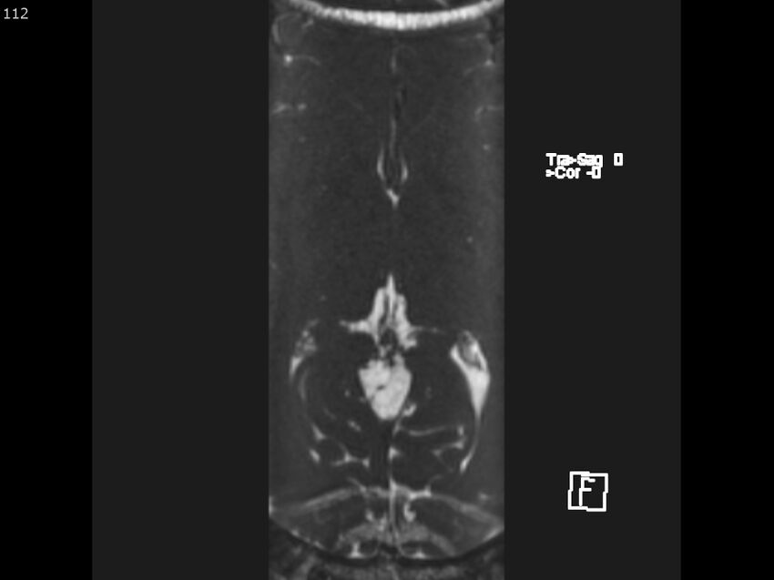 Atypical meningioma - intraosseous (Radiopaedia 64915-74572 Axial CISS 112).jpg