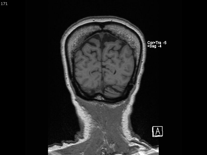 File:Atypical meningioma - intraosseous (Radiopaedia 64915-74572 Coronal T1 171).jpg