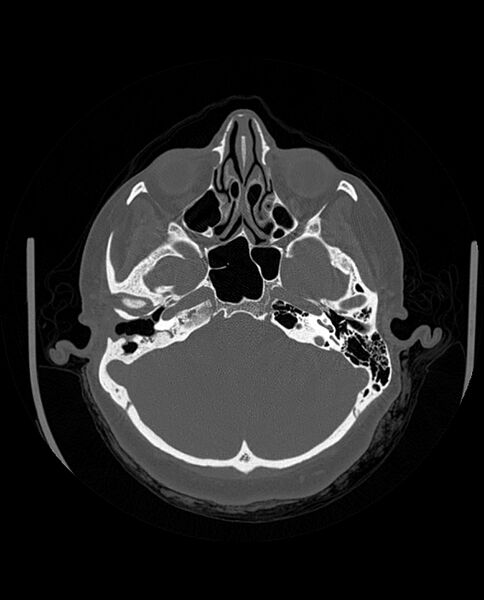 File:Automastoidectomy with labyrinthine fistula (Radiopaedia 84143-99411 Axial non-contrast 83).jpg