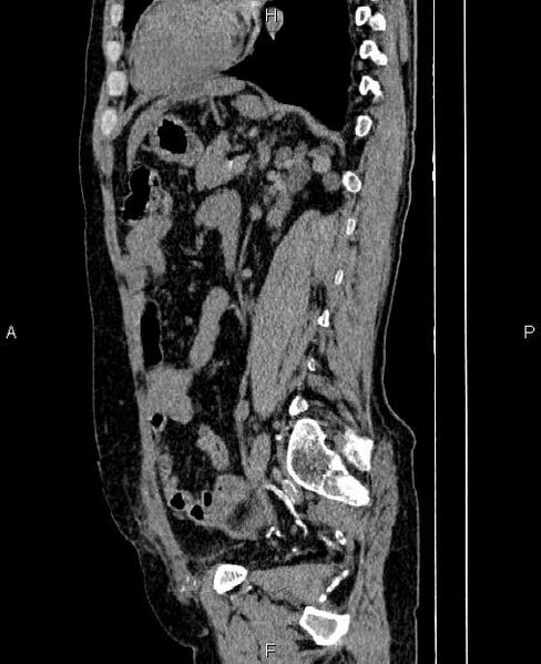 File:Autosomal dominant polycystic kidney disease (Radiopaedia 87830-104287 C 58).jpg