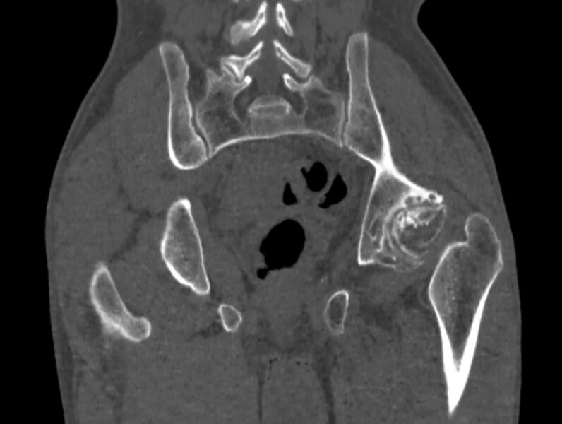 File:Avascular necrosis of the left hip (Radiopaedia 75068-86125 Coronal bone window 64).jpg