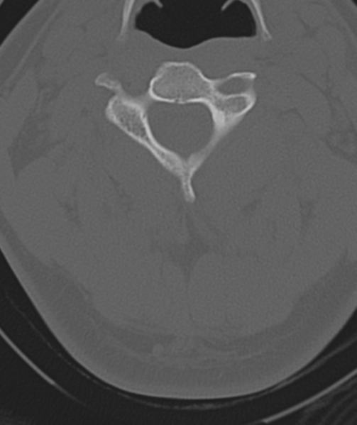 File:Axis peg fracture (type 3) and atlas lateral mass (type 4) fracture (Radiopaedia 37474-39324 Axial bone window 20).png