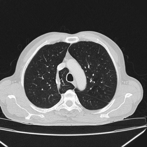File:Azygos lobe (Radiopaedia 38259-40275 Axial lung window 21).jpg