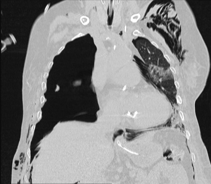 File:Barotrauma due to mechanical ventilation (Radiopaedia 28079-28336 Coronal lung window 45).jpg