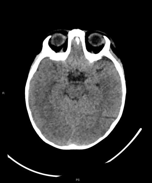 File:Basal ganglia and parenchymal ischemia (Radiopaedia 45818-50083 Axial non-contrast 28).jpg