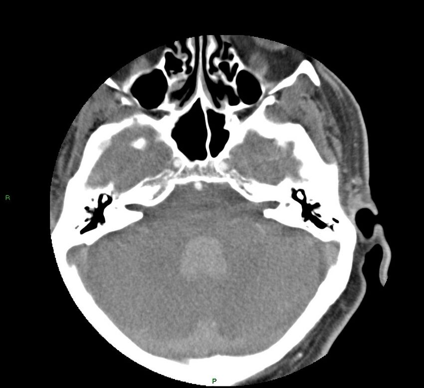Basal ganglia hemorrhage (Radiopaedia 58763-65985 D 50).jpg