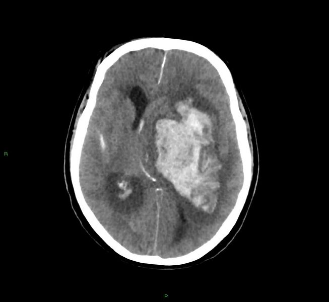 File:Basal ganglia hemorrhage (Radiopaedia 58775-66008 Axial non-contrast 32).jpg