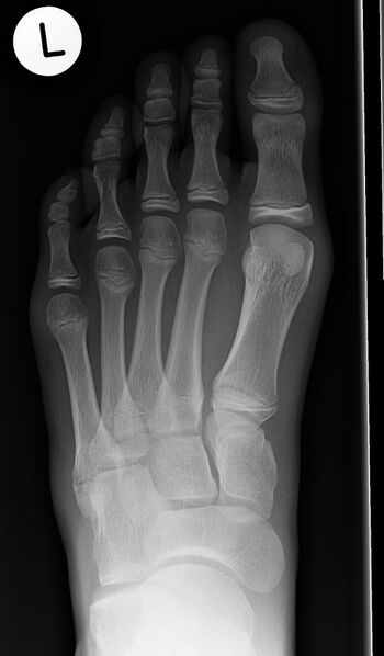 File:Base of 5th metatarsal fracture and apophysis (Radiopaedia 10842-11272 Frontal 1).jpg