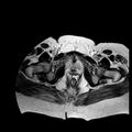 Benign seromucinous cystadenoma of the ovary (Radiopaedia 71065-81300 B 2).jpg