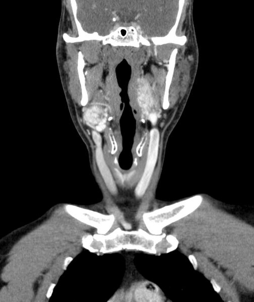 File:Bilateral carotid body tumors (Radiopaedia 52899-58827 B 6).jpg
