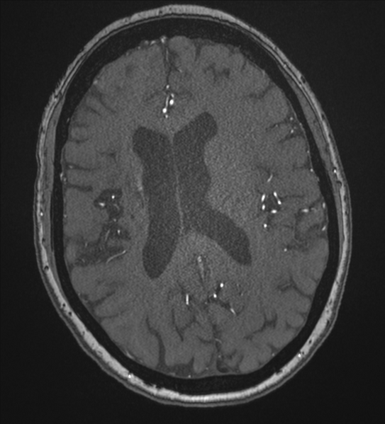 File:Bilateral fetal posterior communicating arteries (Radiopaedia 41286-44102 Axial MRA 135).png