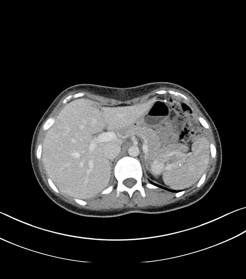 Bilateral kidney malrotation (Radiopaedia 72227-82749 A 2).jpg