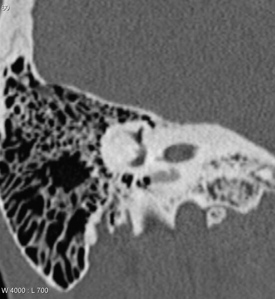 File:Bilateral otosclerosis with left stapes prosthesis (Radiopaedia 5567-7302 Coronal bone window 17).jpg