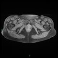 Bilateral ovarian fibroma (Radiopaedia 44568-48293 Axial T1 fat sat 26).jpg