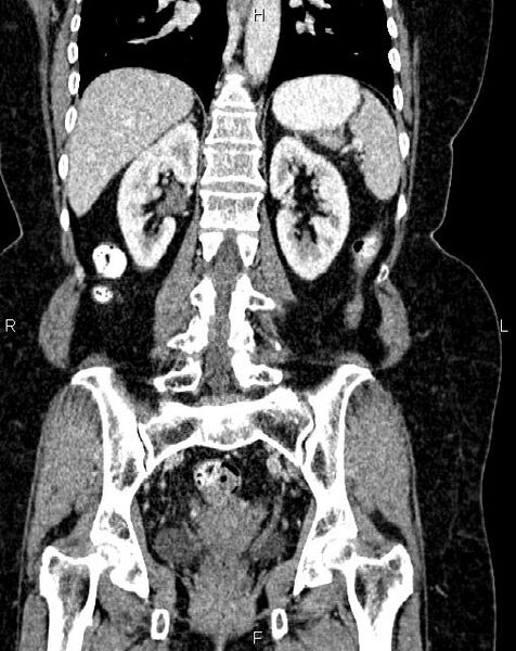 File:Bilateral ovarian serous cystadenocarcinoma (Radiopaedia 86062-101989 D 34).jpg