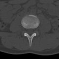 Bilateral pars defect (Radiopaedia 26691-26846 Axial bone window 10).jpg