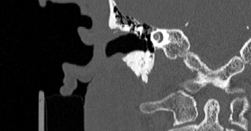 Bilateral temporal bone fractures (Radiopaedia 29482-29970 Coronal non-contrast 97).jpg