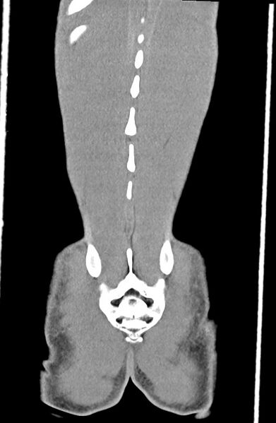 File:Blunt injury to the small bowel (Radiopaedia 74953-85987 B 89).jpg