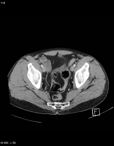 File:Boerhaave syndrome with tension pneumothorax (Radiopaedia 56794-63603 A 59).jpg