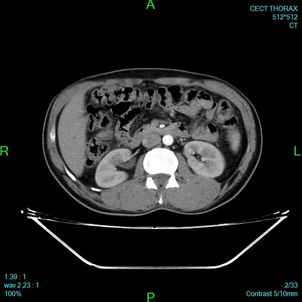 File:Bone metastases from lung carcinoma (Radiopaedia 54703-60937 Axial C+ delayed 2).jpg