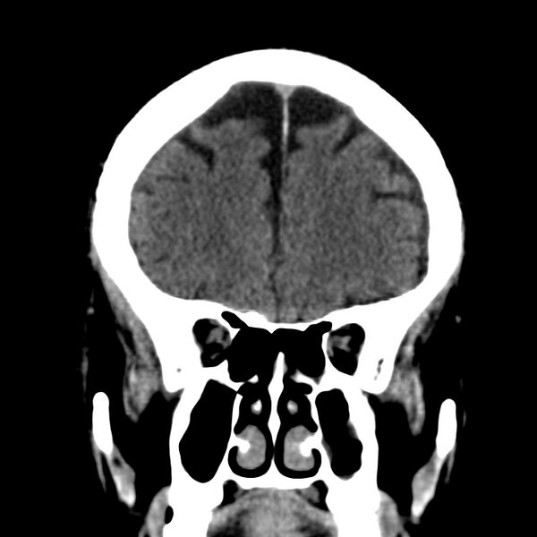 File:Brain Pantopaque remnants (Radiopaedia 78403-91048 Coronal non-contrast 20).jpg